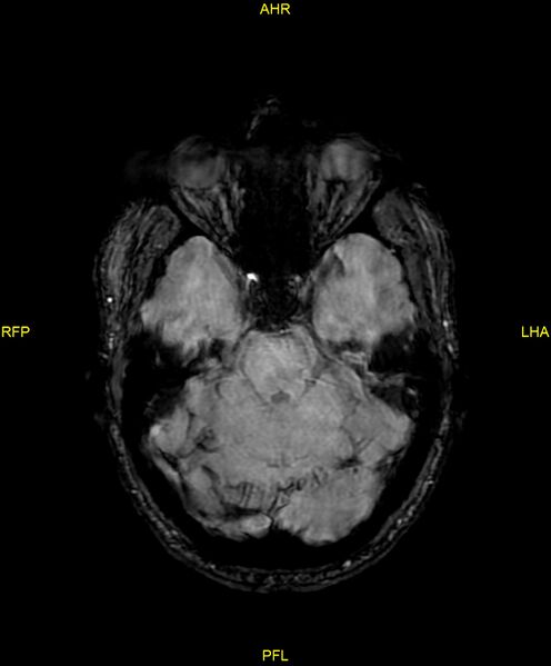 File:Cerebral autosomal dominant arteriopathy with subcortical infarcts and leukoencephalopathy (CADASIL) (Radiopaedia 86108-102054 Axial SWI 37).jpg