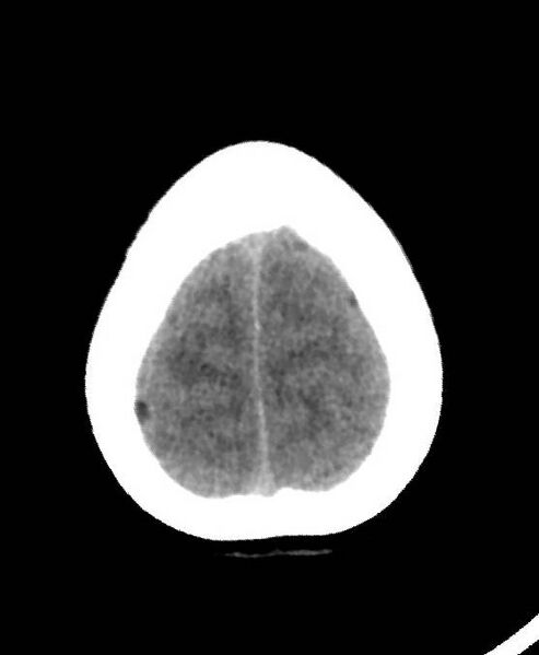 File:Cerebral edema due to severe hyponatremia (Radiopaedia 89826-106937 Axial non-contrast 83).jpg