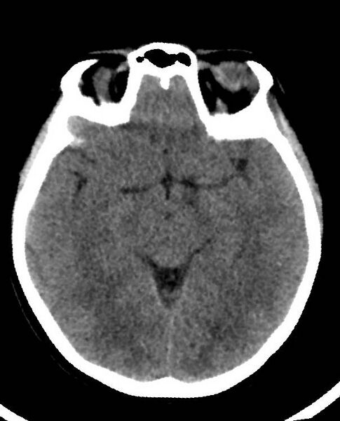 File:Cerebral edema due to severe hyponatremia (Radiopaedia 89826-106938 Axial non-contrast 46).jpg