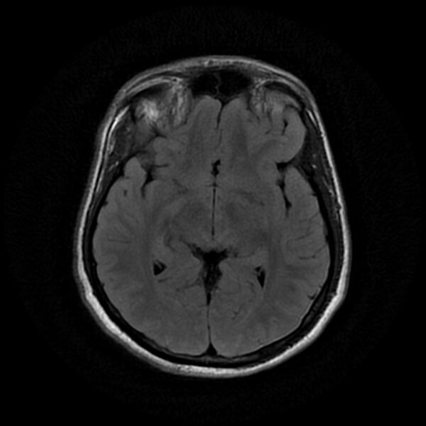 File:Cerebral fat embolism (Radiopaedia 37510-39363 Axial FLAIR 13).jpg