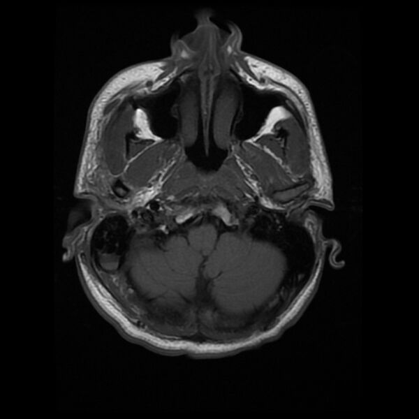 File:Cerebral fat embolism (Radiopaedia 37510-39363 Axial T1 5).jpg