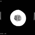 Cerebral hemorrhagic contusion with subdural and subarachnoid hemorrhage (Radiopaedia 10680-19197 Axial non-contrast 24).jpg