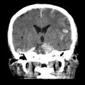 Cerebral hemorrhagic contusions (Radiopaedia 23145-23188 Coronal non-contrast 22).jpg