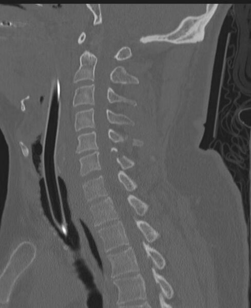 File:Cerebral hemorrhagic contusions and cervical spine fractures (Radiopaedia 32865-33841 Sagittal bone window 48).jpg