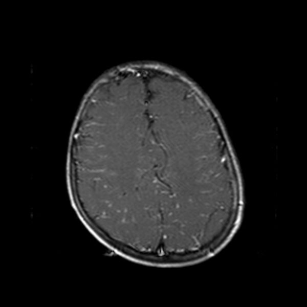 File:Cerebral tuberculoma (Radiopaedia 41152-43932 Axial T1 C+ 17).jpg