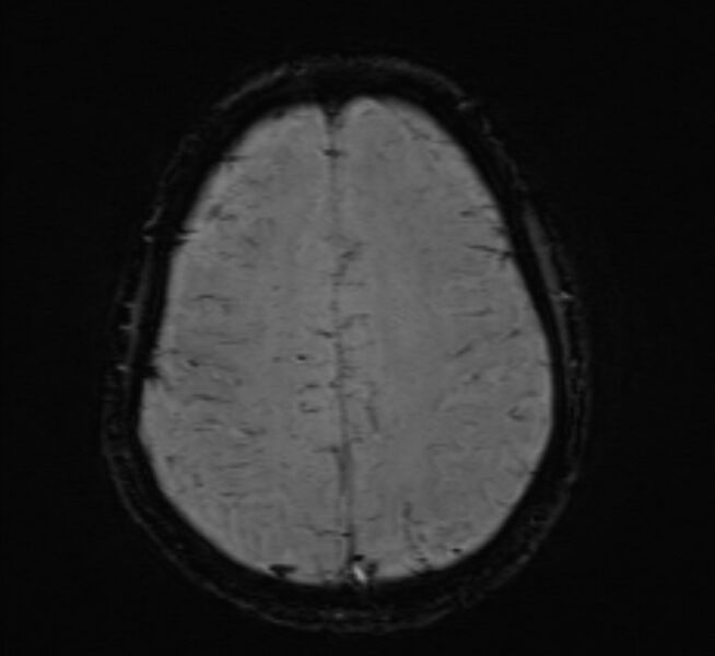 File:Cerebral venous thrombosis (Radiopaedia 71207-81504 Axial SWI 40).jpg