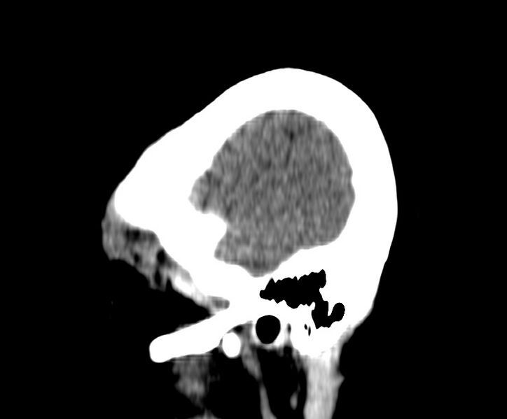 File:Cerebral venous thrombosis - CT only (Radiopaedia 41031-43778 B 44).jpg