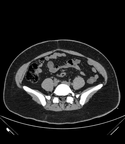 File:Cervical aortic arch with coarctation and aneurysms (Radiopaedia 44035-47552 Axial non-contrast 75).jpg