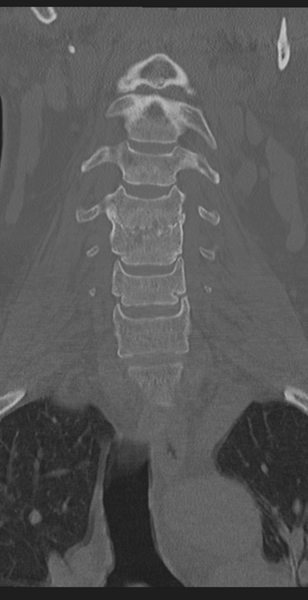 File:Cervical canal stenosis - OPLL and osteophytes (Radiopaedia 47329-51910 Coronal bone window 18).png