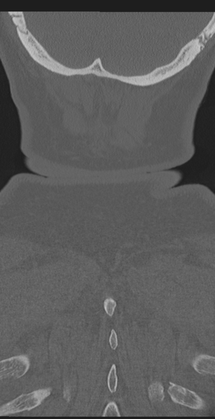 File:Cervical canal stenosis due to ossification of the posterior longitudinal ligament (Radiopaedia 47260-51823 Coronal bone window 68).png