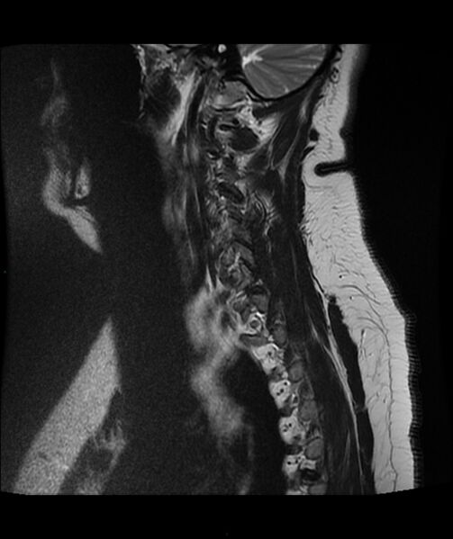 File:Cervical disc prolapse (Radiopaedia 80258-93598 Sagittal T2 1).jpg