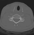 Cervical disc replacement (Radiopaedia 37383-39205 Axial bone window 7).png
