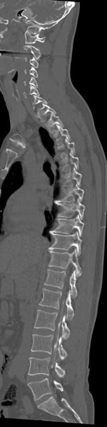File:Cervical dural CSF leak on MRI and CT treated by blood patch (Radiopaedia 49748-54996 A 16).png
