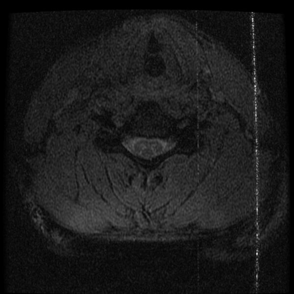 File:Cervical flexion teardrop fracture with cord hemorrhage (Radiopaedia 32497-33455 Axial Gradient Echo 18).jpg