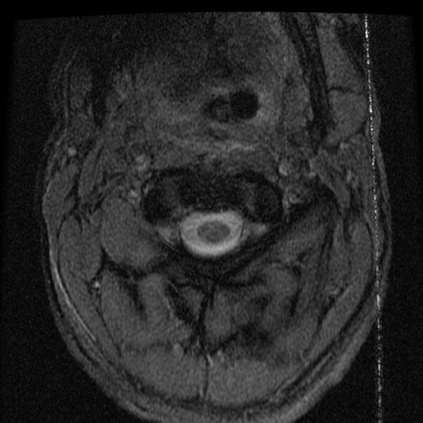File:Cervical flexion teardrop fracture with cord hemorrhage (Radiopaedia 32497-33455 Axial Gradient Echo 2).jpg