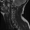 Cervical flexion teardrop fracture with cord hemorrhage (Radiopaedia 32497-33455 Sagittal T2 2).jpg