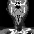Cervical lymphadenopathy- cause unknown (Radiopaedia 22420-22457 C 13).jpg