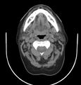 Cervical lymphadenopathy- cause unknown (Radiopaedia 22420-22457 non-contrast 29).jpg