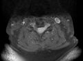 Cervical schwannoma (Radiopaedia 72399-82934 Axial T1 C+ fat sat 9).jpg