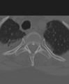 Cervical spine ACDF loosening (Radiopaedia 48998-54071 Axial bone window 60).png