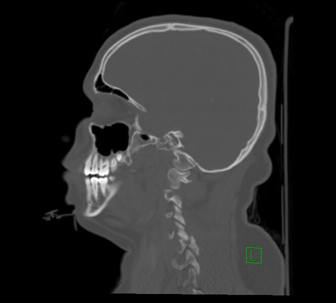 File:Cervical spine fracture - hyperflexion injury (Radiopaedia 66184-75364 A 6).jpg