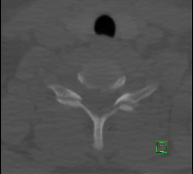 File:Cervical spine fracture - hyperflexion injury (Radiopaedia 66184-75364 Axial bone window 43).jpg