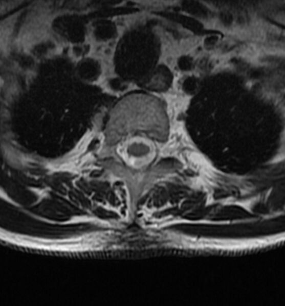 File:Cervical spondylodiscitis (Radiopaedia 81362-95110 Axial T2 23).jpg