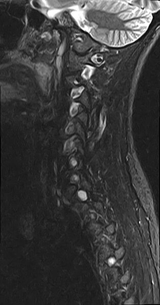 File:Cervical spondylodiscitis and calvarial hemangioma (Radiopaedia 64317-73104 Sagittal STIR 11).jpg