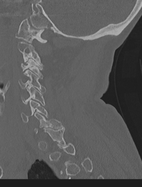File:Cervical spondylolysis (Radiopaedia 49616-54811 Sagittal bone window 50).png
