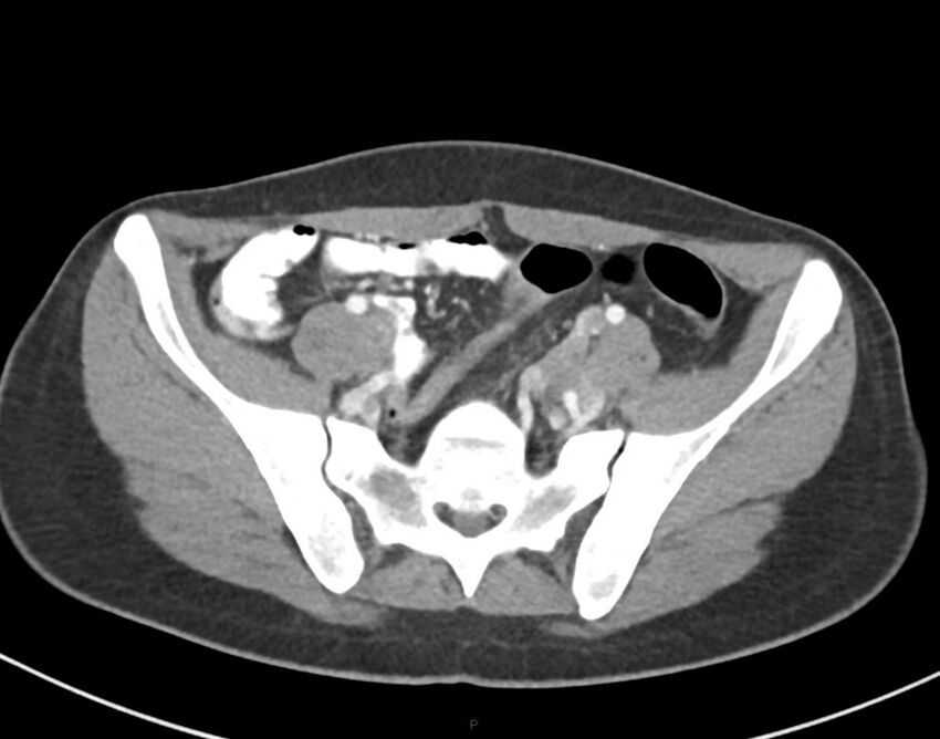 Cesarean scar endometriosis (Radiopaedia 82925-97262 A 64).jpg