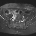 Cesarian section scar endometriosis (Radiopaedia 66520-75799 Axial T2 fat sat 4).jpg