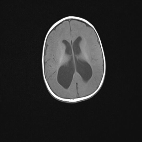 File:Chiari III malformation with occipital encephalocele (Radiopaedia 79446-92559 Axial T1 17).jpg