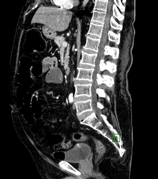 File:Cholangiocarcinoma with cerebral metastases (Radiopaedia 83519-98629 F 62).jpg