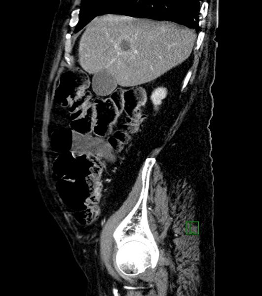 File:Cholangiocarcinoma with cerebral metastases (Radiopaedia 83519-98629 F 92).jpg