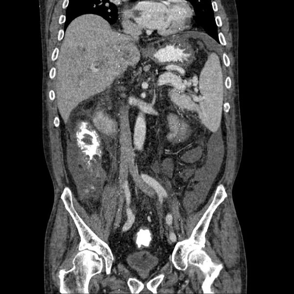 File:Cholangitis and abscess formation in a patient with cholangiocarcinoma (Radiopaedia 21194-21100 C 11).jpg