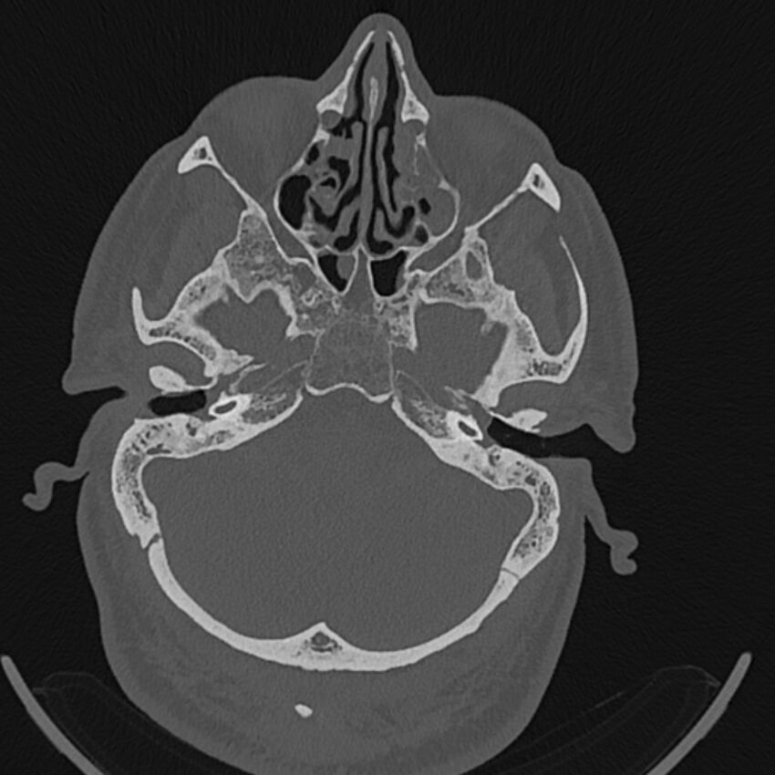 Cholesteatoma (Radiopaedia 68176-77673 Axial bone window 33).jpg