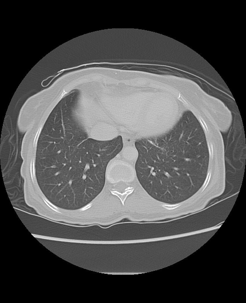 Chondrosarcoma (Radiopaedia 79427-92532 Axial lung window 44).jpg