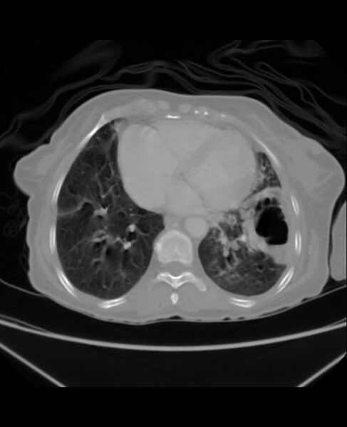 File:Chondrosarcoma (Radiopaedia 79427-92535 Axial lung window 37).jpg
