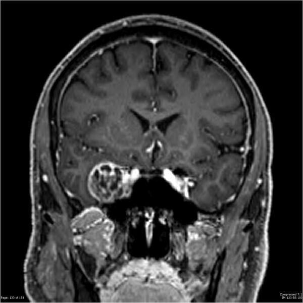 File:Chondrosarcoma of skull base- grade II (Radiopaedia 40948-43654 Coronal T1 C+ 34).jpg