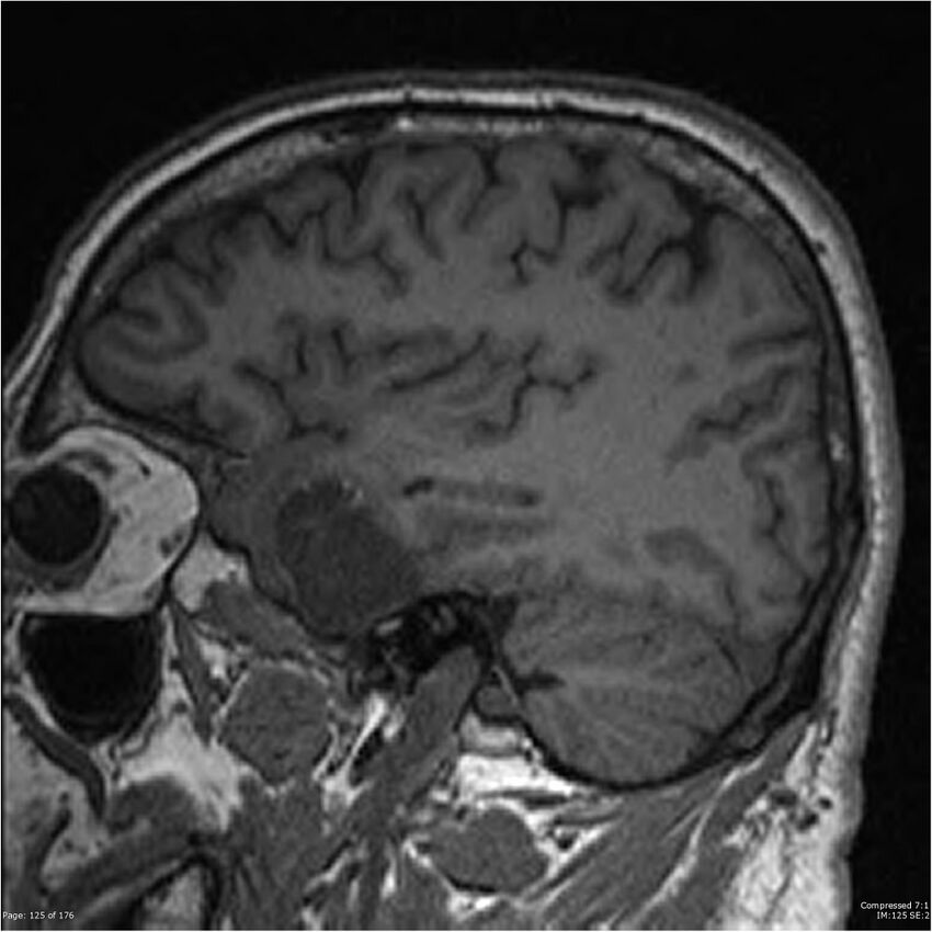 Chondrosarcoma of skull base- grade II (Radiopaedia 40948-43654 Sagittal T1 48).jpg