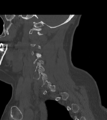 Chordoma (C4 vertebra) (Radiopaedia 47561-52188 Sagittal bone window 23).png