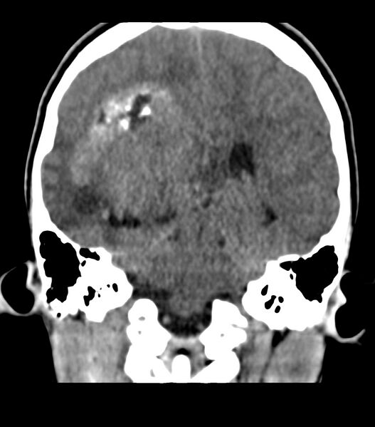 File:Choroid plexus carcinoma (Radiopaedia 91013-108552 Coronal non-contrast 54).jpg