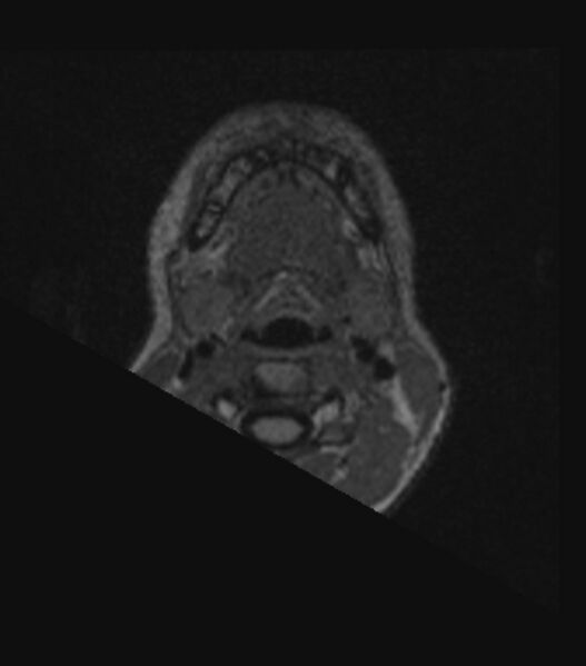 File:Choroid plexus carcinoma (Radiopaedia 91013-108553 Axial FLAIR C+ 19).jpg