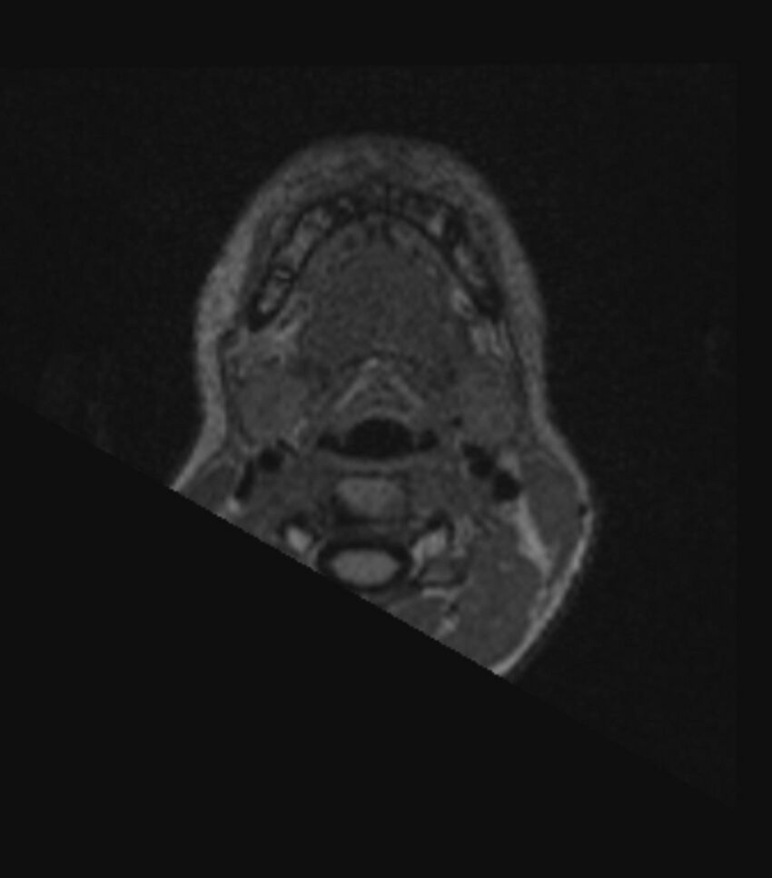 Choroid plexus carcinoma (Radiopaedia 91013-108553 Axial FLAIR C+ 19).jpg