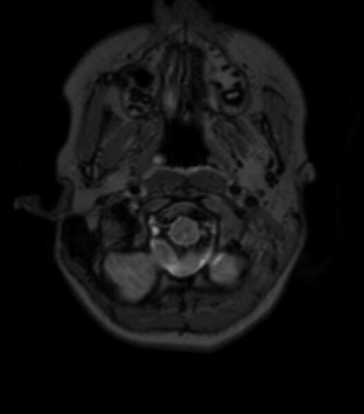 File:Choroid plexus carcinoma (Radiopaedia 91013-108553 Axial T2 fat sat 29).jpg