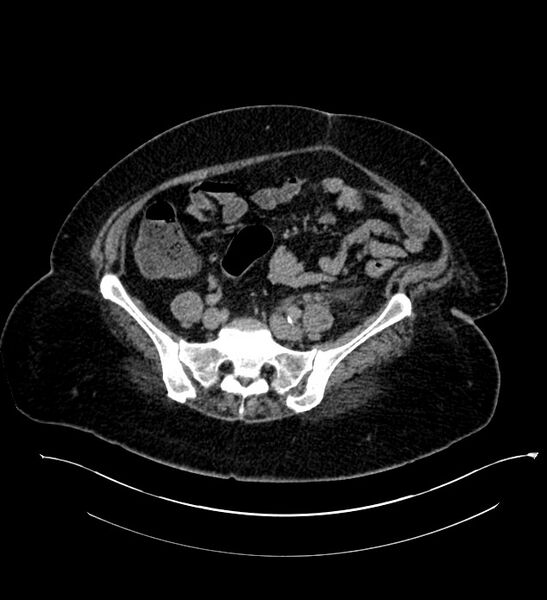 File:Chromophobe renal cell carcinoma (Radiopaedia 84239-99519 E 114).jpg