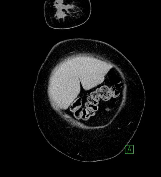 File:Chromophobe renal cell carcinoma (Radiopaedia 84239-99519 F 9).jpg