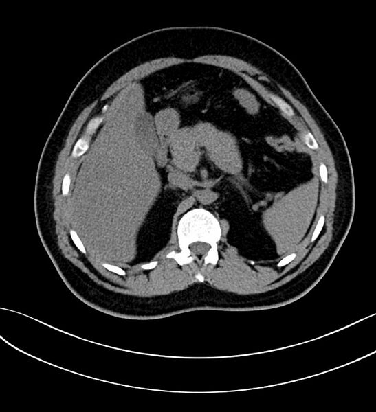 File:Chromophobe renal cell carcinoma (Radiopaedia 84286-99573 Axial non-contrast 13).jpg