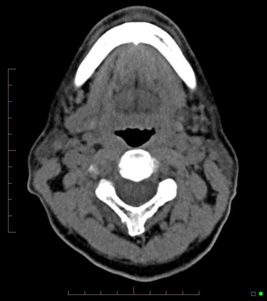 File:Chronic Submandibular sialolithiasis (Radiopaedia 16880-16606 Axial non-contrast 16).jpg