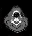 Chronic Submandibular sialolithiasis (Radiopaedia 16880-16606 Axial non-contrast 21).jpg